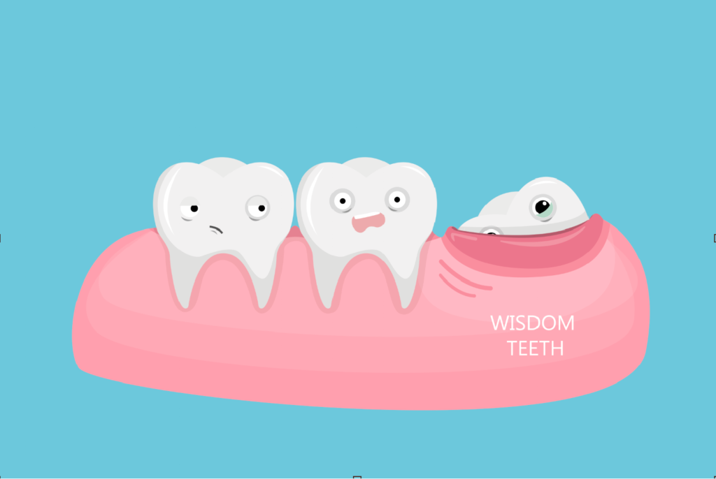 The Risks of Not Removing Wisdom Teeth